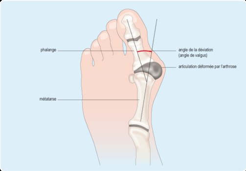 hallus valgus