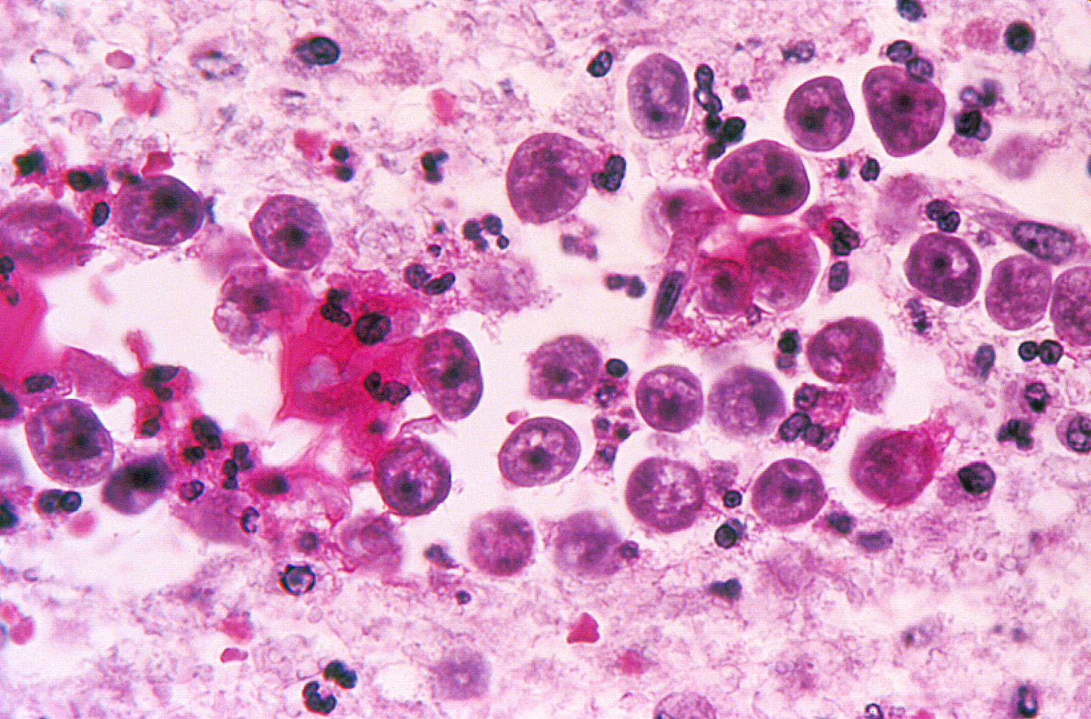 BrainEating Amoeba, Naegleria Fowleri, Confirmed In Louisiana Parish