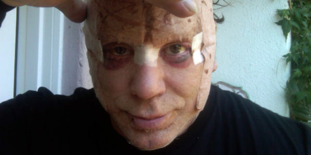 Mickey Rourke Plastic Surgery: Actor Looks Gruesome In Post-Surgery