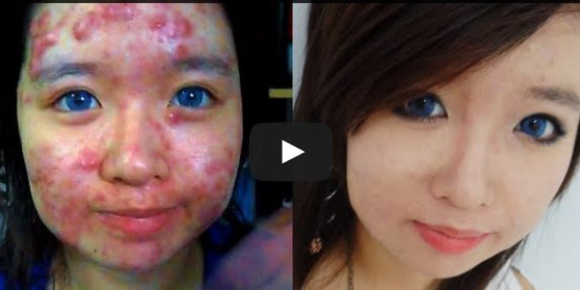 This Incredible Video Shows You How To Cover Up Acne HuffPost