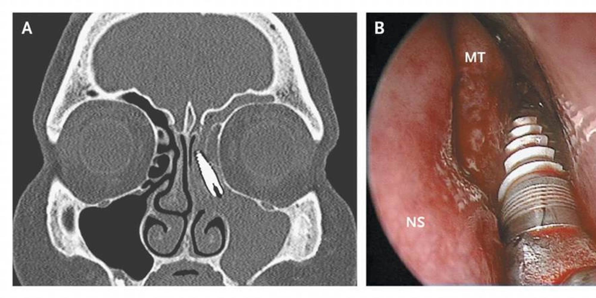 Dental Implant Ends Up In Womans Sinus X Ray Photo Will Give You A 4524