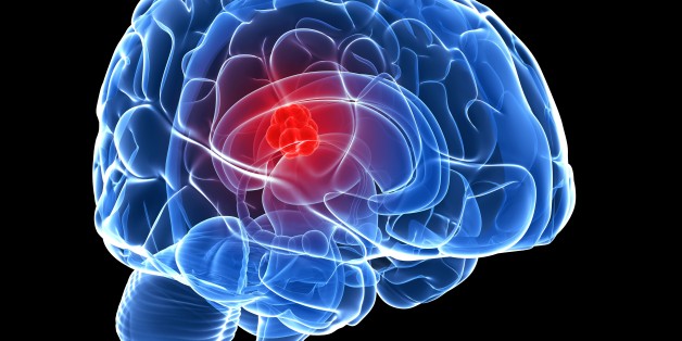 Thinking Can Fuel The Growth Of Brain Tumors Study Finds HuffPost