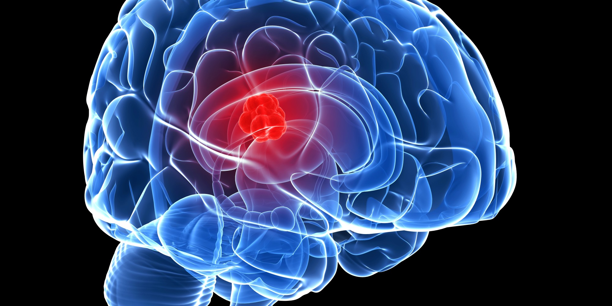 What Does A Terminal Brain Tumours Mean