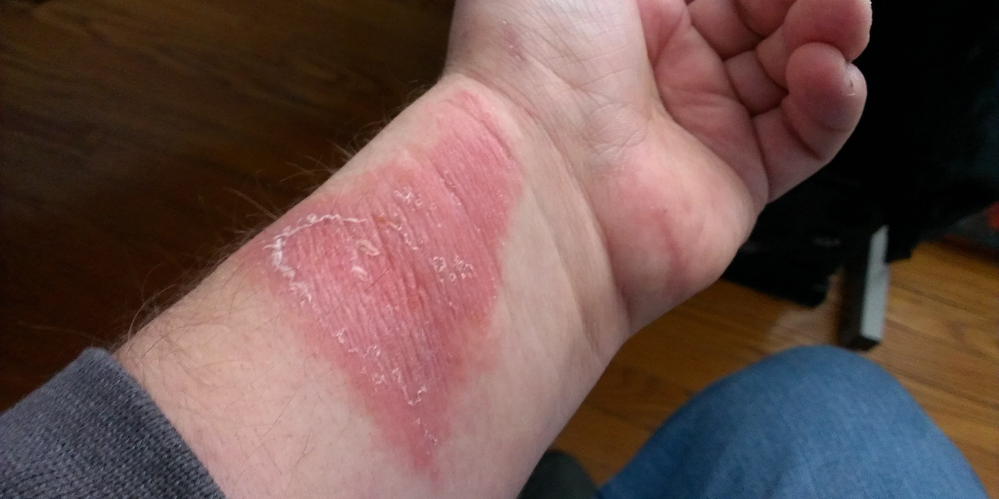 Some Fitbit Force Owners Complain Of Severe Skin Irritation HuffPost   O FITBIT FORCE Facebook 