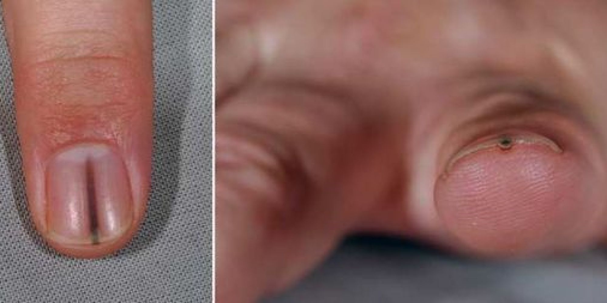 splinter-under-man-s-nail-turns-out-to-be-tumor-photo-huffpost