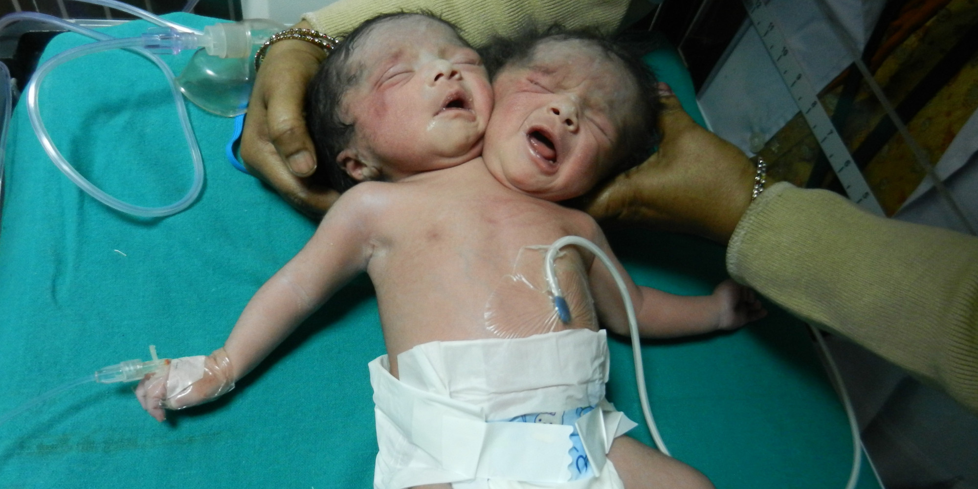 Female Baby Having Two Heads Born In India HuffPost image