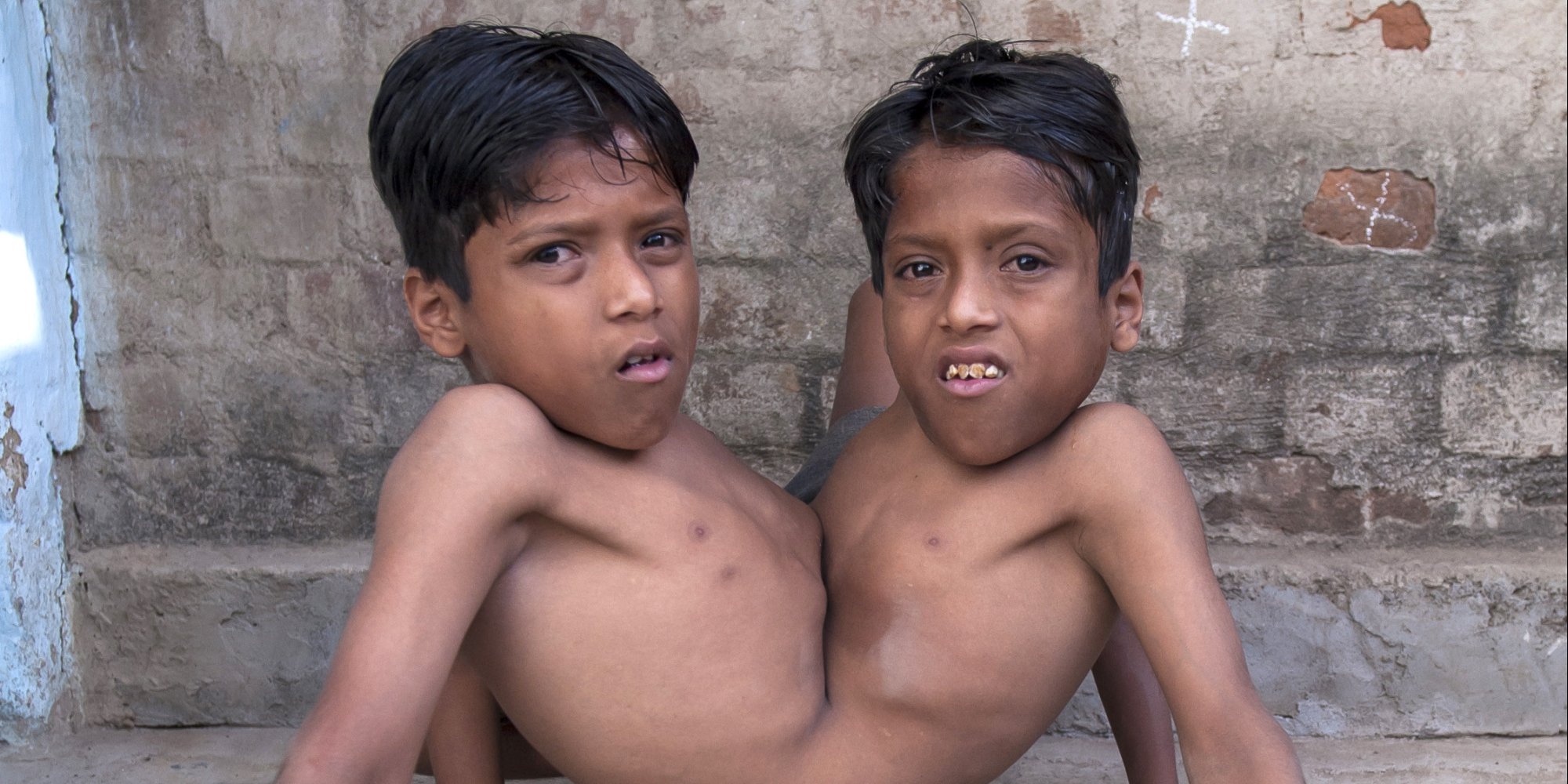 Conjoined Twins Shivanath and Shivram Sahu Perfect The 'Spider Walk