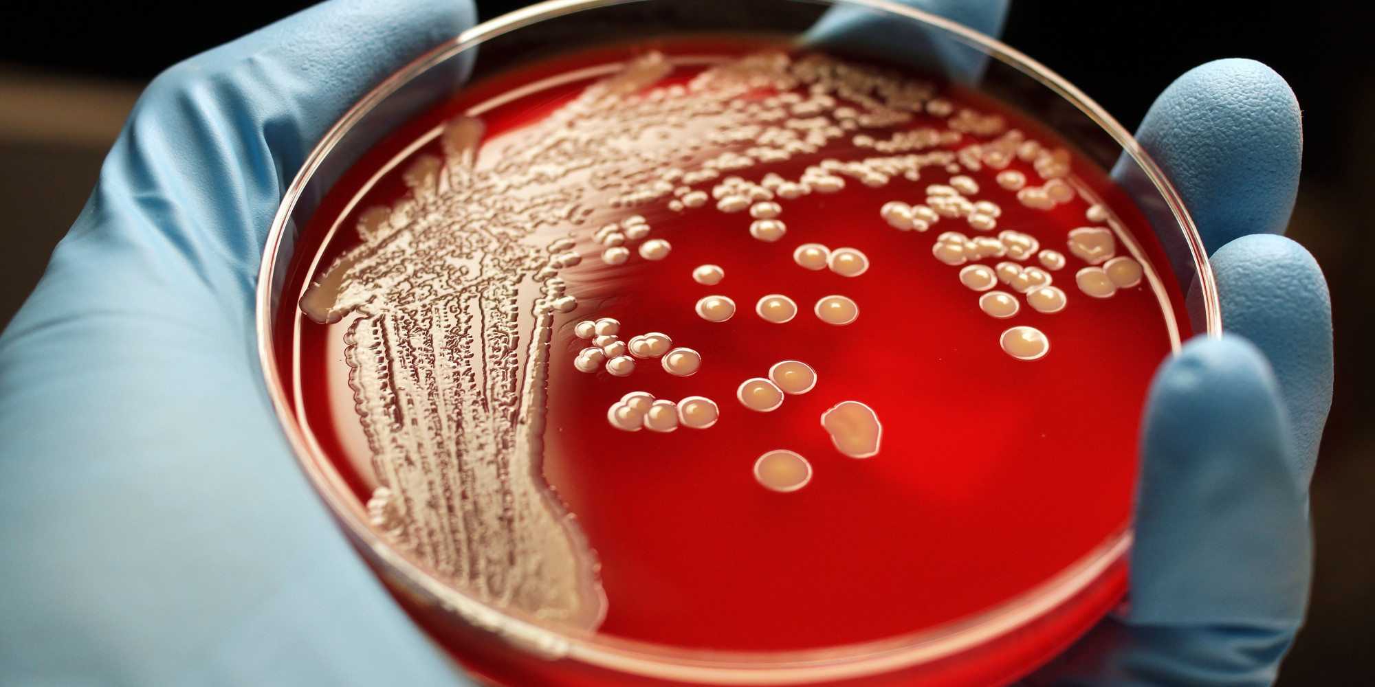 New Mrsa Superbug Emerges In Brazilian Patient Huffpost