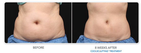 coolsculpting