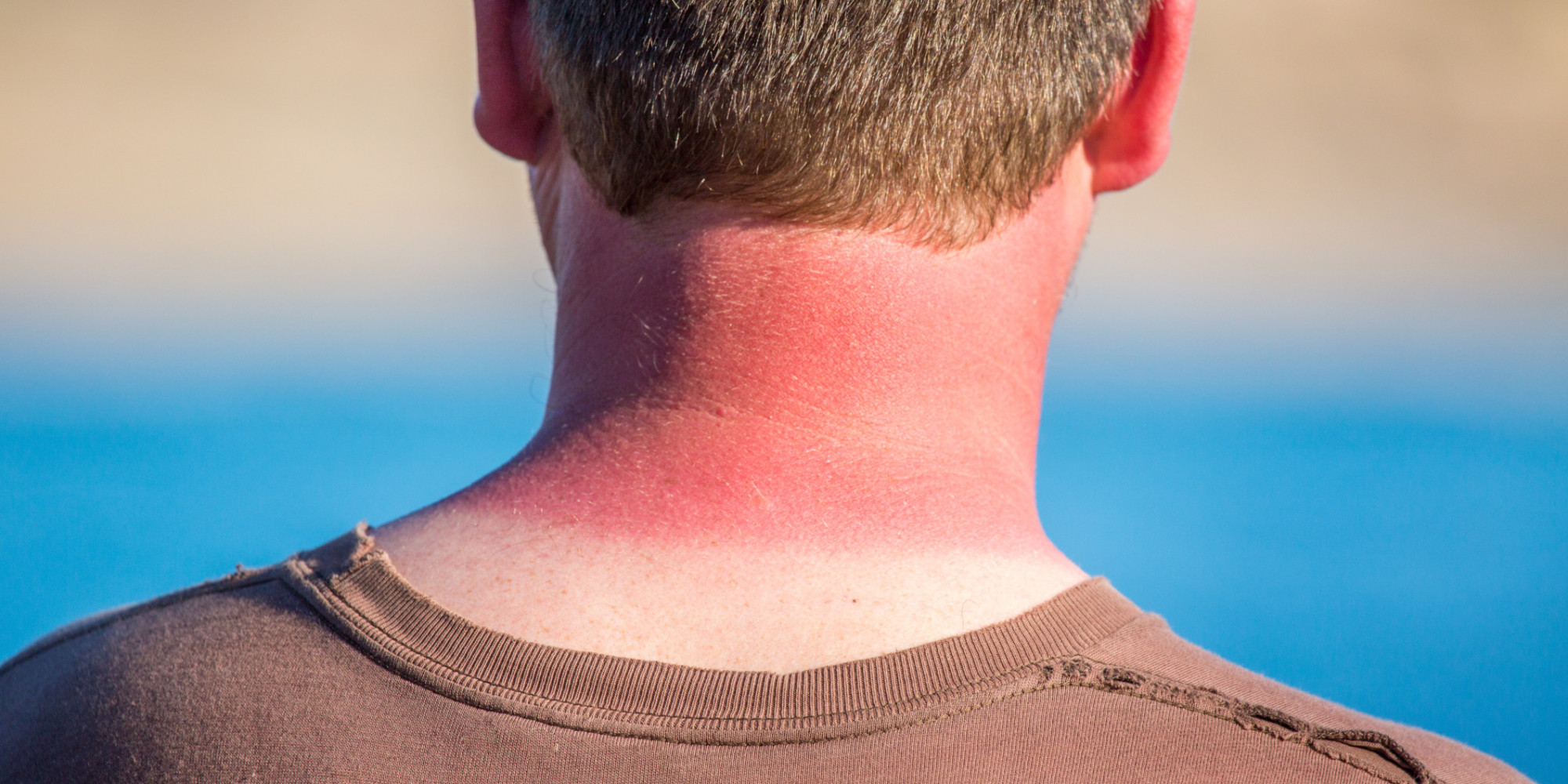 what is good for a really bad sunburn