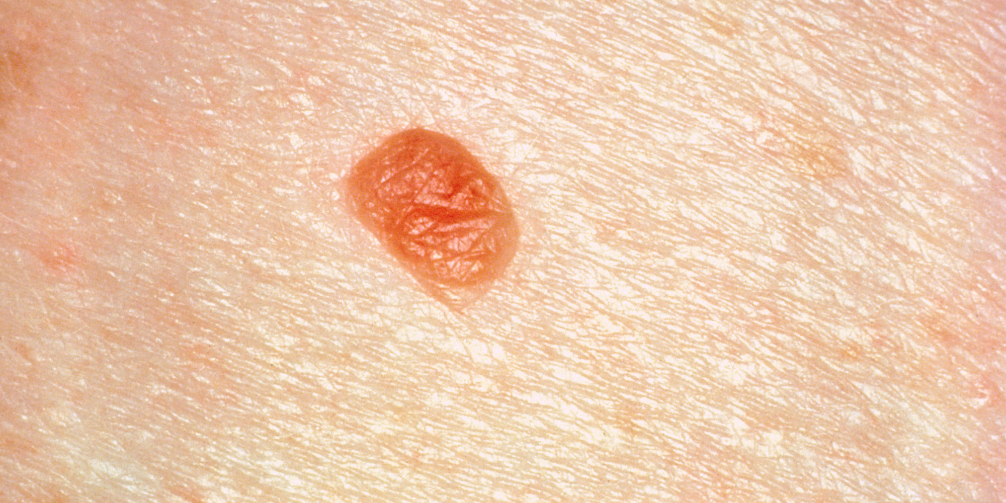 What Moles Might Have To Do With Breast Cancer Risk HuffPost