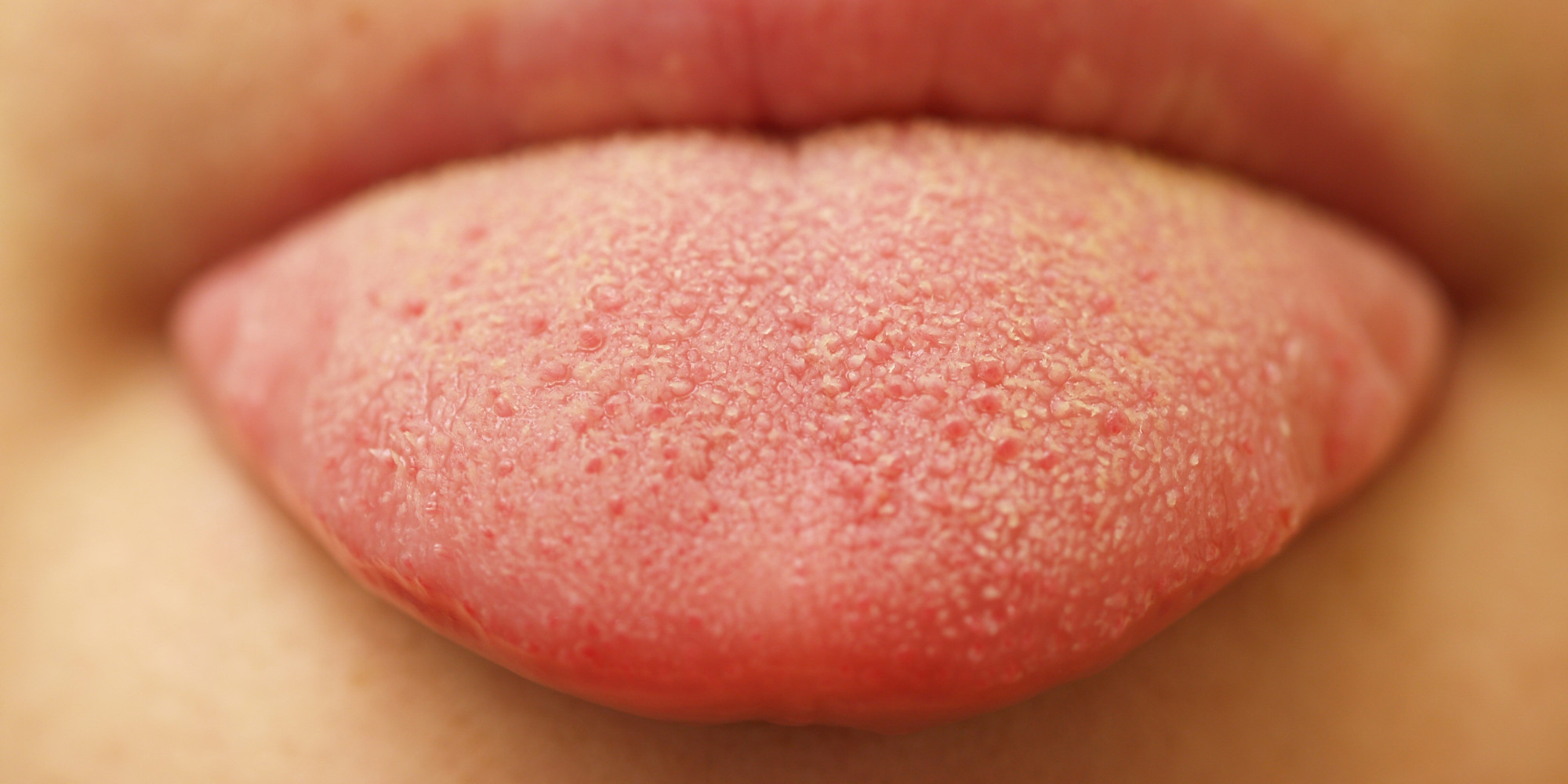 Oral Thrush What Bumps On Your Tongue May Be Telling You Huffpost 6339