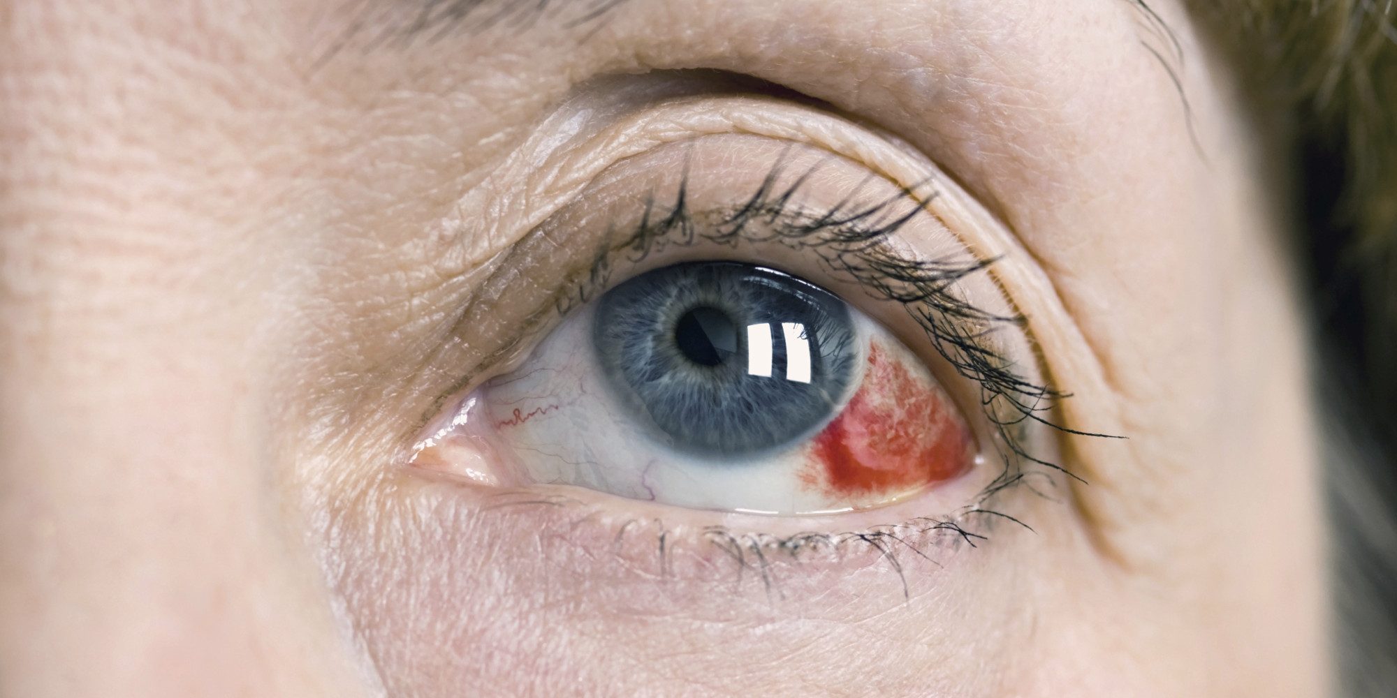 Can Diabetes Make Your Eyes Bloodshot