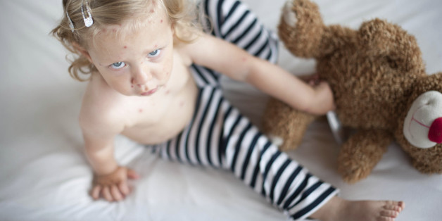 Masern: Eltern, die sich jetzt nicht impfen lassen, gefährden das Leben von Babys
