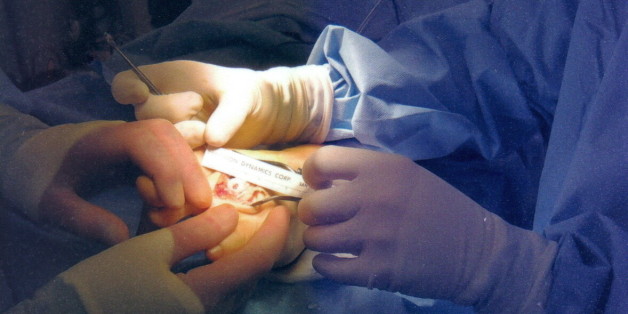 Second metatarsal with erosion in the articular cartilage. This was an arthroplasty and osteotomy of the second metatarsal. I am the set of hands in the foreground.