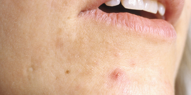 Cystic Acne On Chin And Neck