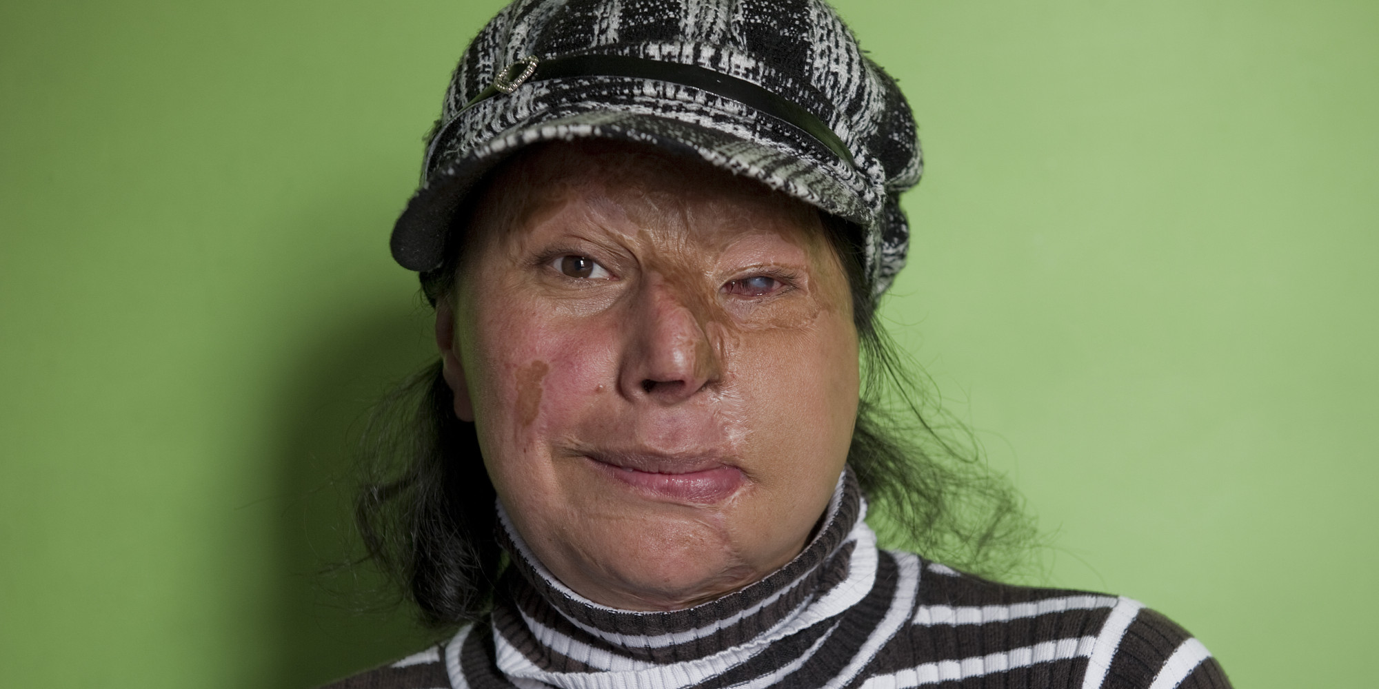 Fighting For The Rights Of Colombia's Acid Attack Victims HuffPost