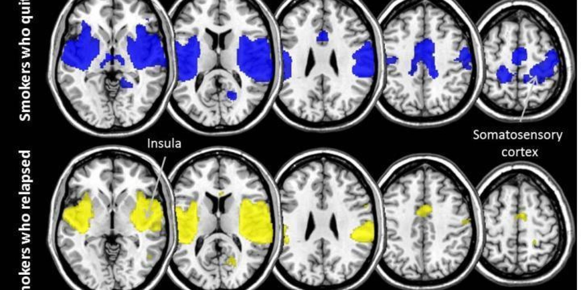 What Studying The Brains Of Smokers Reveals About Quitting Successfully
