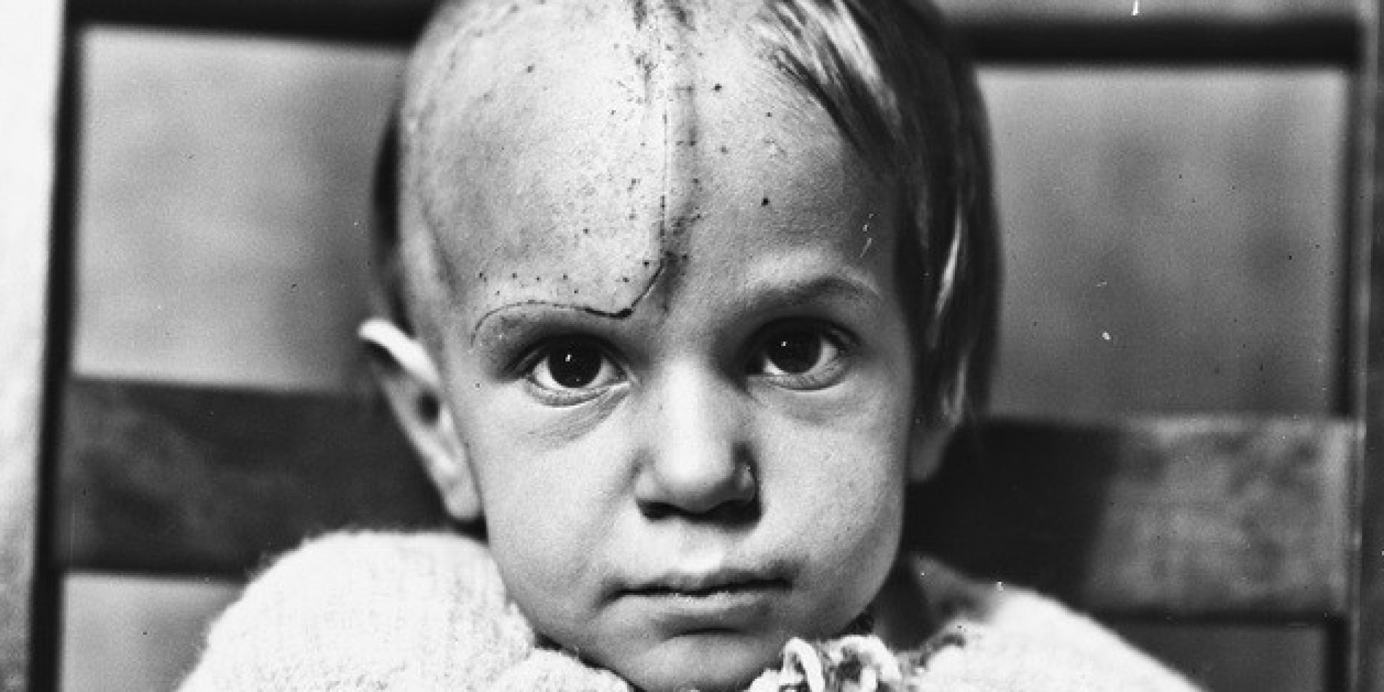 These Haunting Photos Show The Faces Of Brain Surgery Patients In The