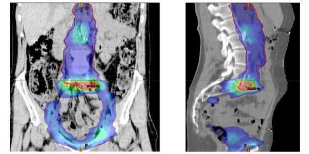 Citation: von Eyben FE, Joensuu T, Kangasmaki A, Kairemo K, Kiljunen T. Abiraterone and Volumetric Modulated Arc Therapy for Second Recurrence of Node-Positive Prostate Cancer - A Case Report. Journal of Diagnostic Imaging in Therapy. 2014; 1(1): 73-80.
<a href="http://dx.doi.org/10.17229/jdit.2014-1028-005" rel="nofollow">dx.doi.org/10.17229/jdit.2014-1028-005</a>
Abstract
A 50 year old man with prostate cancer was initially treated with radical prostatectomy and pelvic lymph node dissection. He had salvage androgen deprivation therapy (ADT) for persistent measurable prostate specific antigen (PSA). In 2011, the first recurrence was treated with volumetric modulated arc therapy (VMAT). However in 2014, an 11C-choline PET/CT scan indicated a second recurrence with new lesions, in two para-aortal lymph nodes. Abiraterone (Zytiga®) gave a fall of PSA from 2.9 to 0.54 ng/mL over four month period. Following this, a para-aortal lymph node lesion was given VMAT with a boost of 60 Gy. The treatment was well tolerated.
Keywords: Abiraterone, external beam radiotherapy, PET/CT scanning, prostate cancer