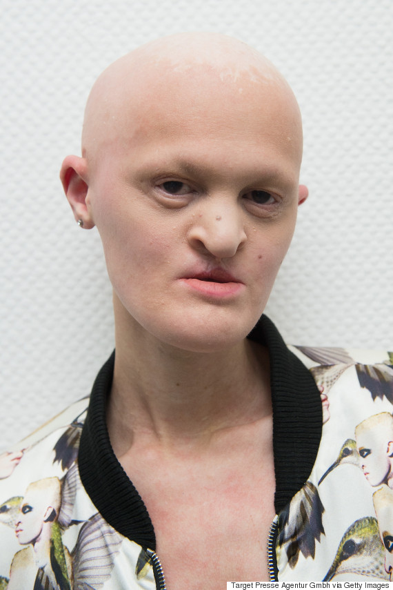 Melanie Gaydos: Model With Ectodermal Dysplasia Is Making Waves In The ...