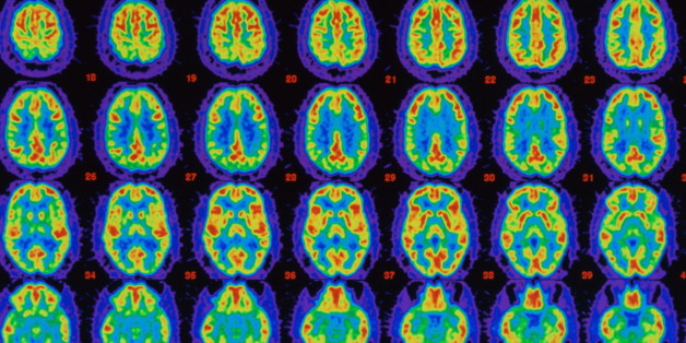 Eine neue Alzheimer-Therapie stellt die Gedächtnisleistung fast vollständig wieder her
