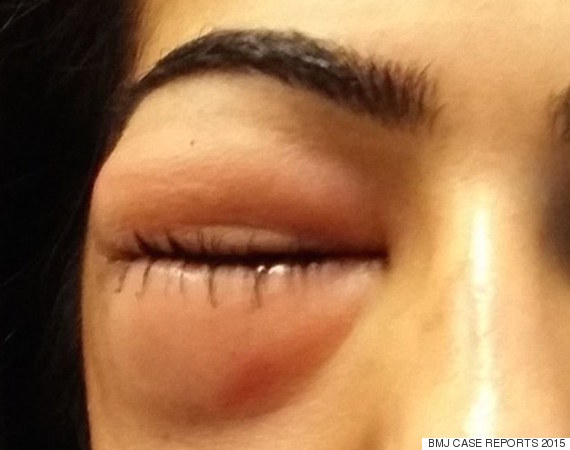 woman-left-with-severely-swollen-eye-after-blowing-her-nose-too-hard