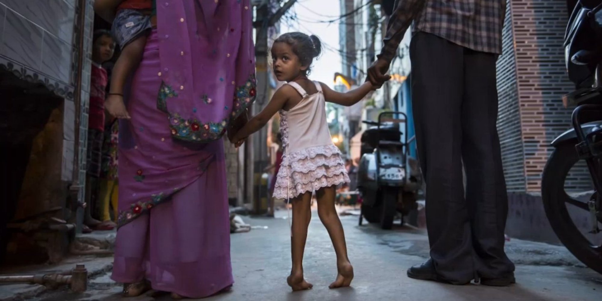 Watch Clubfoot Needn t Be A Life Sentence As These Doctors 