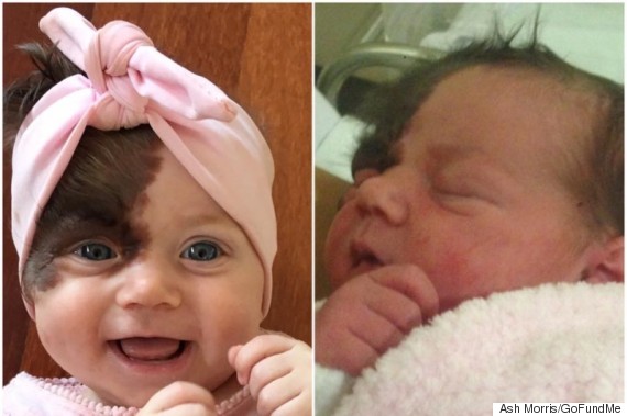 Baby Set To Undergo Seven Operations To Remove Hairy Birthmark Covering