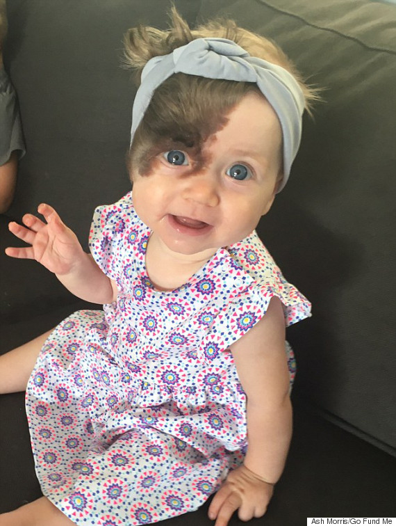 Baby Set To Undergo Seven Operations To Remove Hairy Birthmark Covering