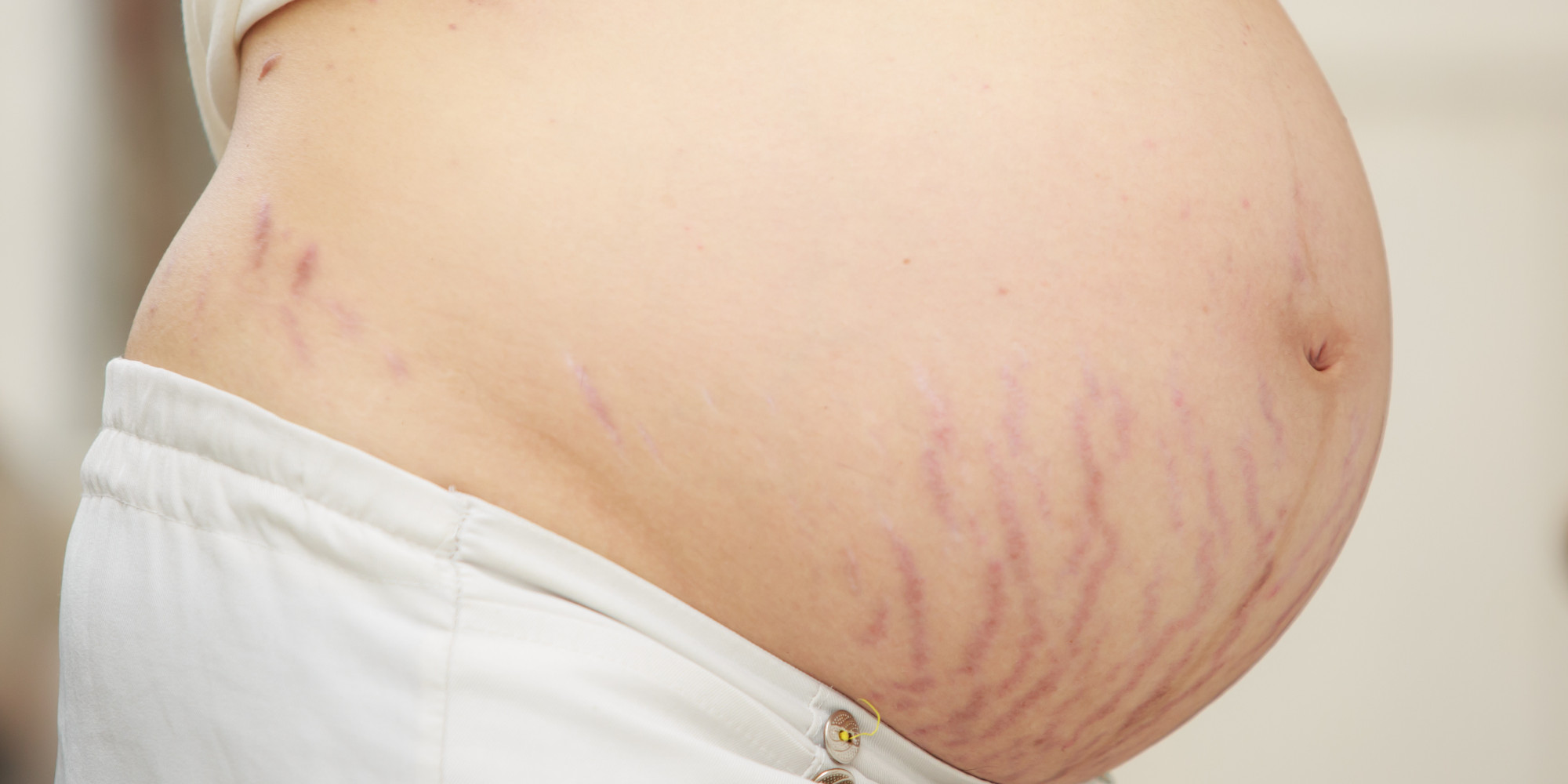 pregnancy stretch marks