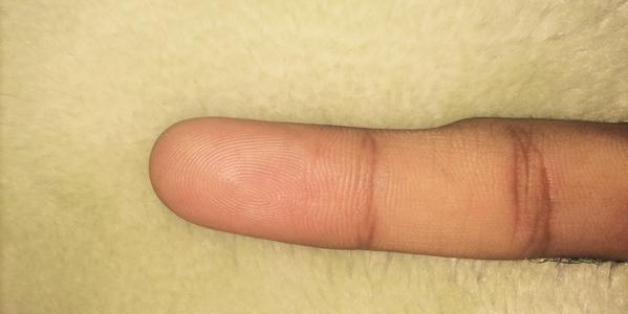 Tausende Menschen entdecken diese Delle an ihrem kleinen Finger- und glauben den Grund zu kennen