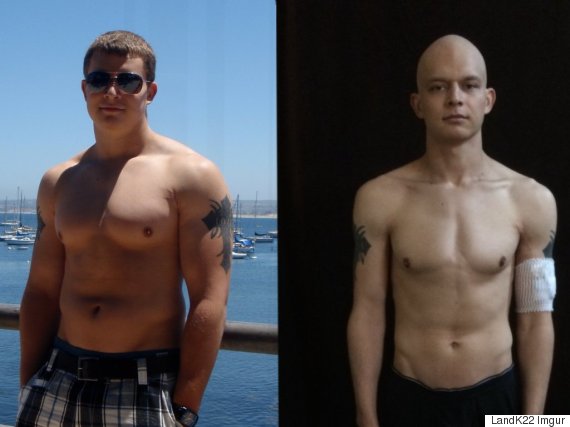 Testicular Cancer Fighter Shares Positive Before And After Chemo Photo Prompting Men To Get 