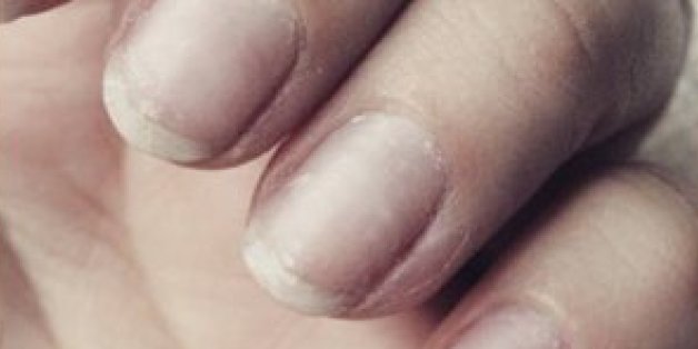 Wenn eure Fingernägel so aussehen, solltet ihr sofort zum Arzt gehen