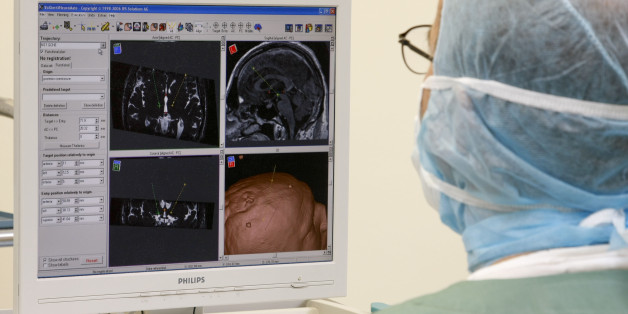 Photo Essay At The Regional University Hospital Of Lille, Salengro Hospital, Department Of Neurosurgery. Photo Essay At The Regional University Hospital Of Lille, Salengro Hospital, Department Of Neurosurgtreatment Of Parkinson's Disease By Bilateral Thalamic Stimulation. Processing Of Imageries By Neurosurgeons Scanner And Mri. It Is An Electrical Stimulation Undertaken Through An Electrode Placed At The Level Of A Thalamic Nucleus, The Ventral Intermediate Nucleus Vim. This Electrode Is Set Up Surgically, Thanks To A Nanopositioning System, After Neuroradiological Spotting, Undertaken Under 3D Mri, And Neurophysiological By Detection And Recording Of Cellular Activities. The Electrode Is Linked To A Programmable Subcutaneous Stimulator. The Intervention Can Be Bilateral. A Quadripolar Electrode, Proposed After The Initial Notice Of The Ceditcomitee For Evaluation And Diffusion Of Innovative Technologies, Has Rapidly Imposed To Different Teams Using This Technique ; The Evacuation Protocole Has Been Amended Accordingly. (Photo By BSIP/UIG Via Getty Images)