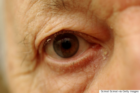 What Is Eye Gunk And Why Do We Get It HuffPost Canada