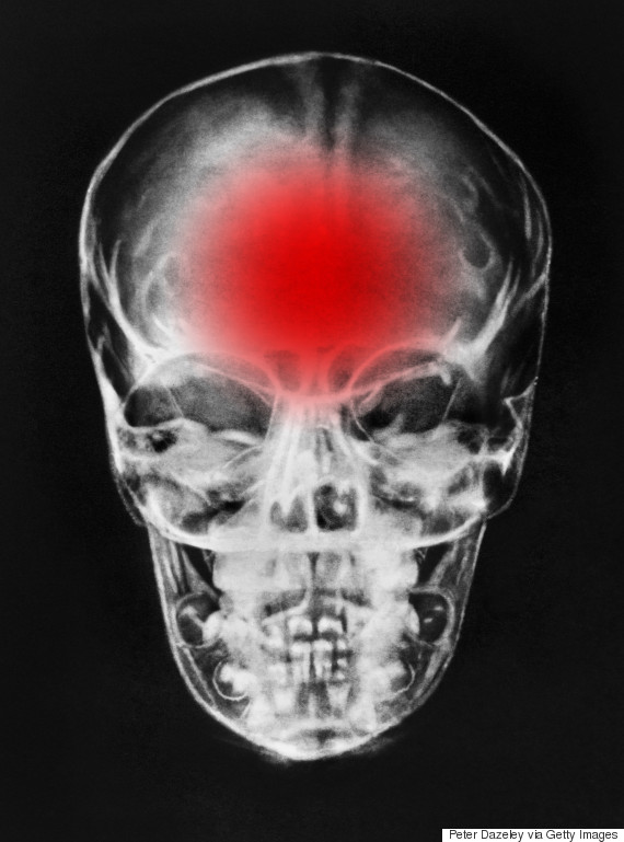 6 Concussion Symptoms And Other Facts About This Head