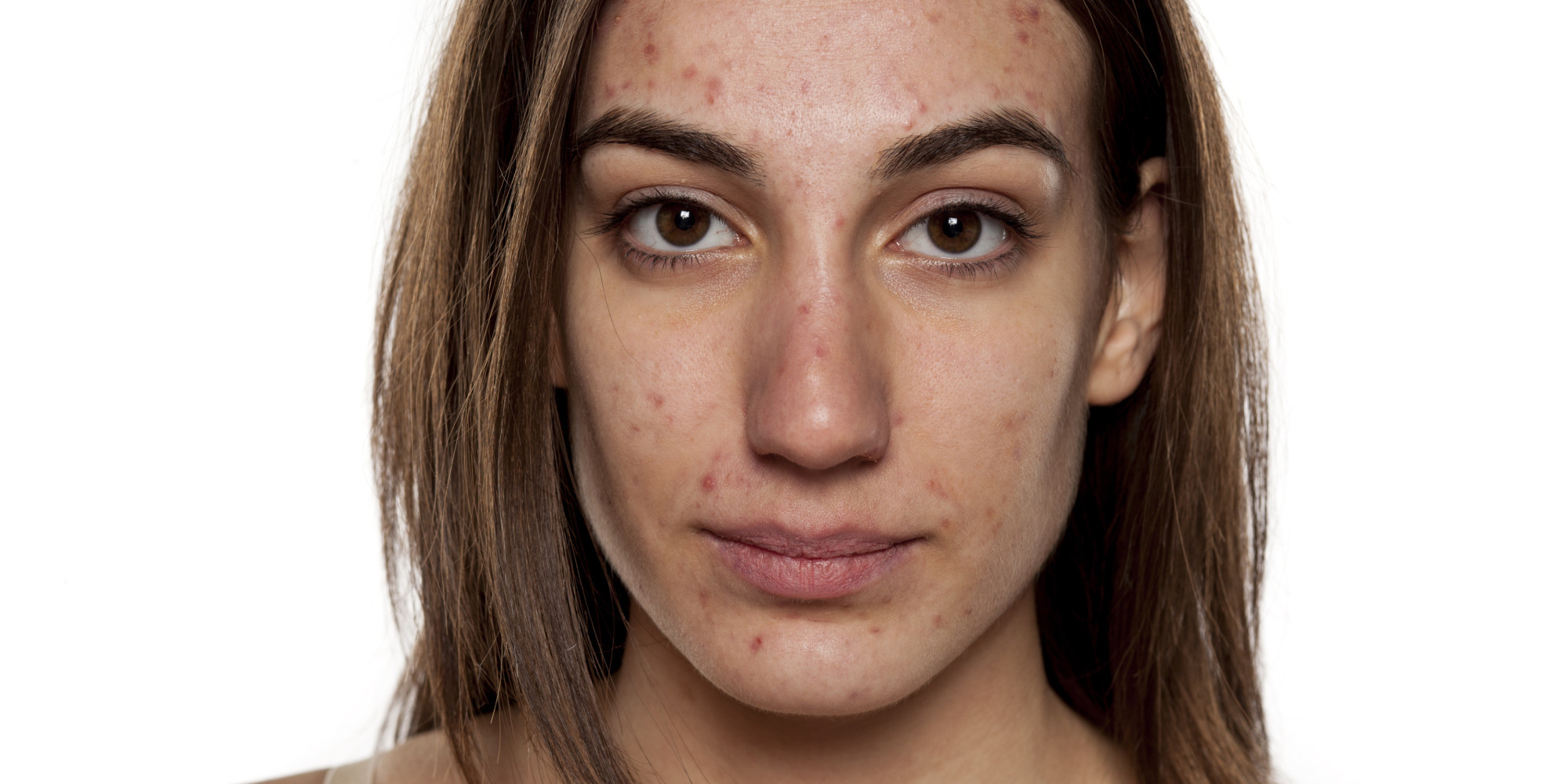 How Having Adult Acne Made Me More Accepting Of Other Women Huffpost