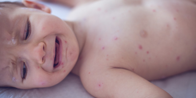 Crying baby girl with measles