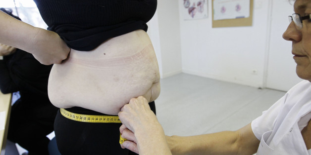 A nurse measures an obese patient at the office of surgeon Dr. Alexandre Lesage's to prepare for surgery at the Saint Jean d'Angely Hospital, in Saint Jean d'Angley, southwestern France, January 24, 2013. The patient hopes to lose some 50 kilos (110 pounds) in the next year after she undergoes surgery for obesity. Picture taken January 24, 2013. REUTERS/Regis Duvignau (FRANCE - Tags: HEALTH)