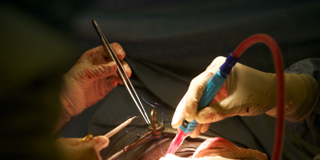 Kidney transplant surgery