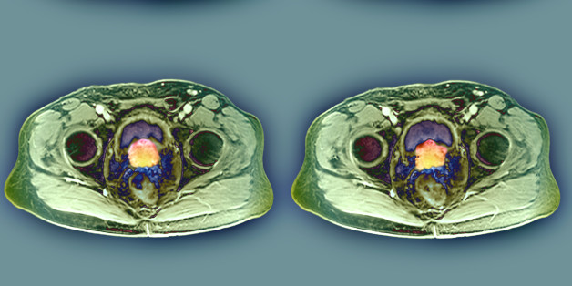 Prostate cancer