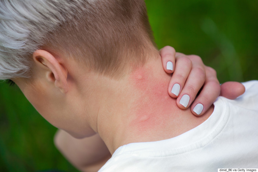 stop mosquito bite itch and swelling