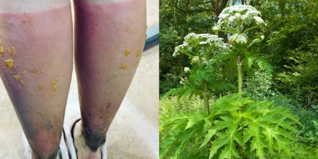 Die Frau dachte, sie hätte Sonnenbrand - doch Schuld an der Verbrennung