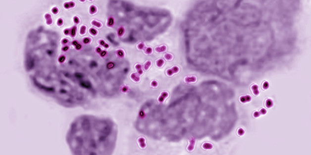 Gonococci Or Neisseria Gonorrhoeae In An Uretral Pus. This Bacterium Is Reponsible For Gonorrhea Blennorrhagia Or Clap, Urethritis, Vaginitis Sexually Transmitted Disease. Microscopy X 600. (Photo By BSIP/UIG Via Getty Images)