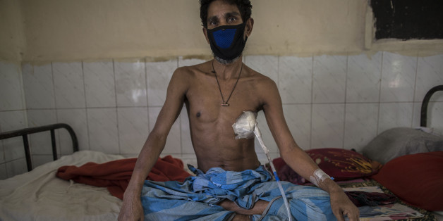DHAKA, BANGLADESH - 2017/03/24: AMIR HOSSAIN (45) has been suffering from TB for last 2 months at National Institute of Diseases of Chest and Hospital on World Tuberculosis Day in Dhaka, Bangladesh, Friday, March 24, 2017. He receives daily injections and has tube put into infected lung to drain that. Tuberculosis (TB) is a worldwide public health problem. The incident of TB is much higher in developing countries such as Bangladesh. The country ranks sixth among 22 highest burden TB countries in