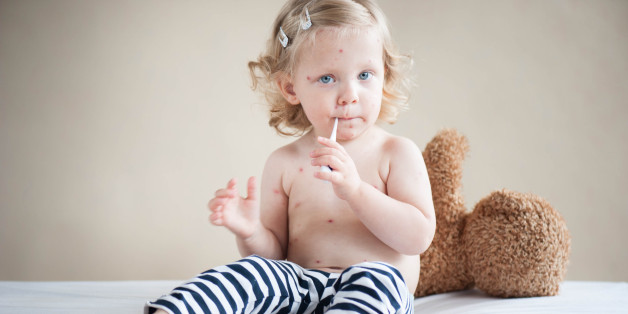 Chickenpox