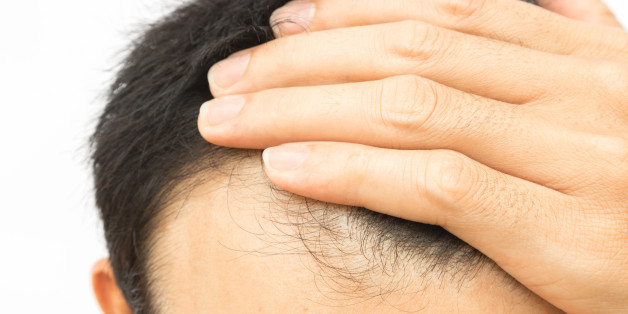 Closeup young man serious hair loss problem for hair loss concept or shampoo product, health care and medical
