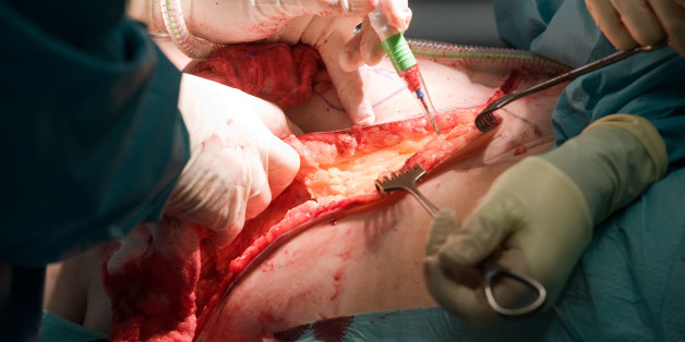 A surgeon team working together on a patient during an oparation in a hospital