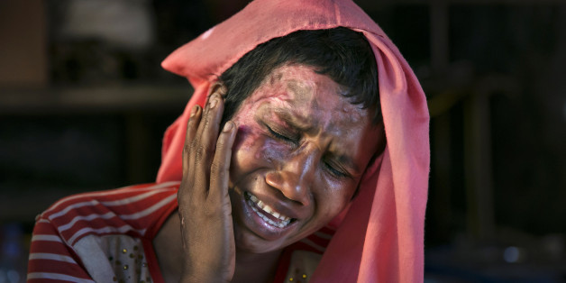 COX'S BAZAR, BANGLADESH - DECEMBER 02: Mumtaz Begum, 30, becomes emotional as she touches the wounds she received when the military set her house on fire after raping her, on December 2, 2017 in Cox's Bazar, Bangladesh. She fled to Bangladesh shortly after the August 25th attack from Tula Toli village in Myanmar. She fled to Bangladesh shortly after the August 25th attack. She says that one night the military attacked her village and burned homes. Everyone ran and hid but the military found them